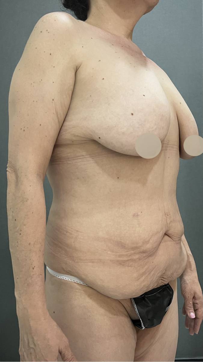 LIPOSUCCION ABDOMINOPLASTIA Y MASTOPEXIA CON IMPLANTES — antes