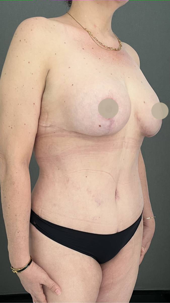 LIPOSUCCION ABDOMINOPLASTIA Y MASTOPEXIA CON IMPLANTES — después