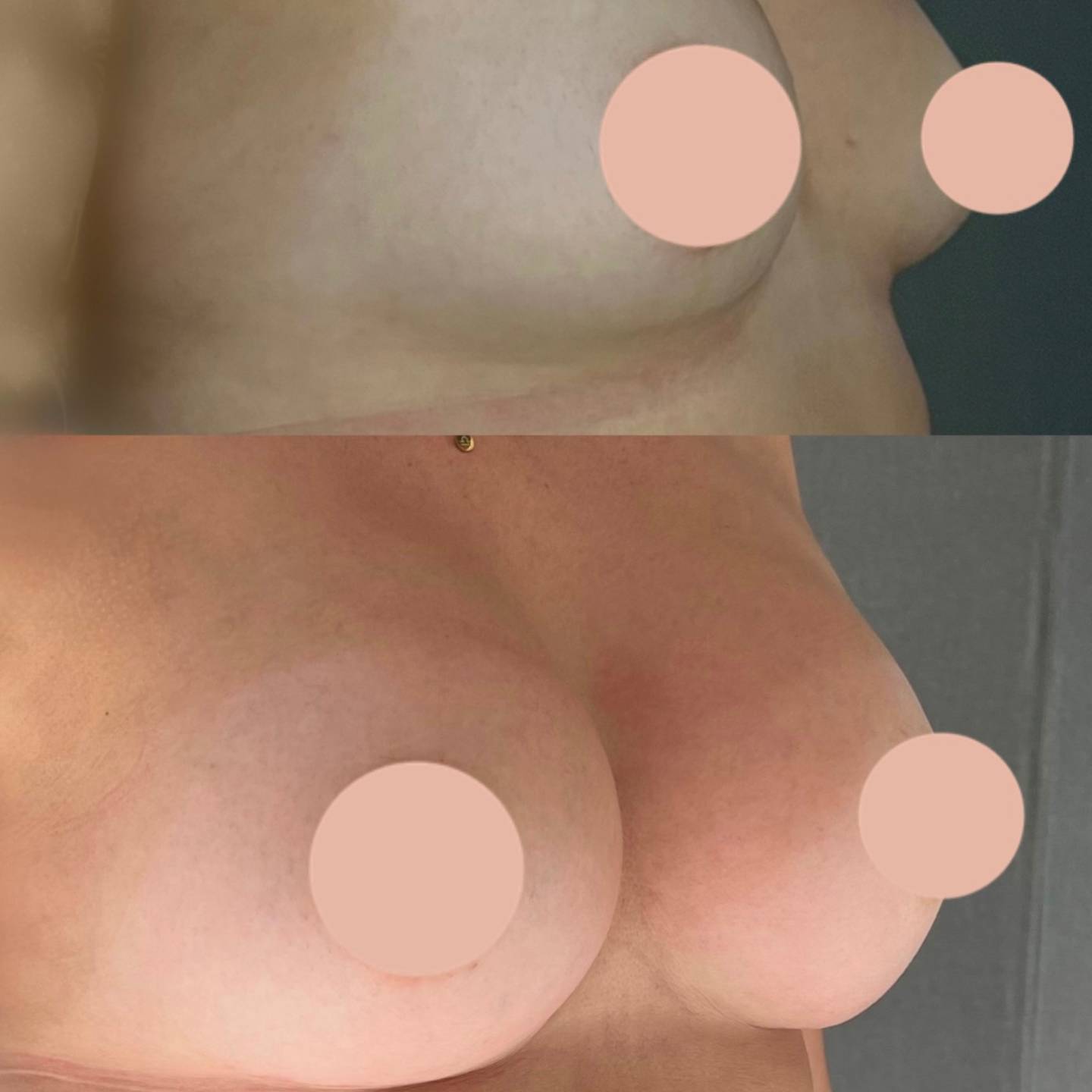 MAMA DE AUMENTO CON IMPLANTES