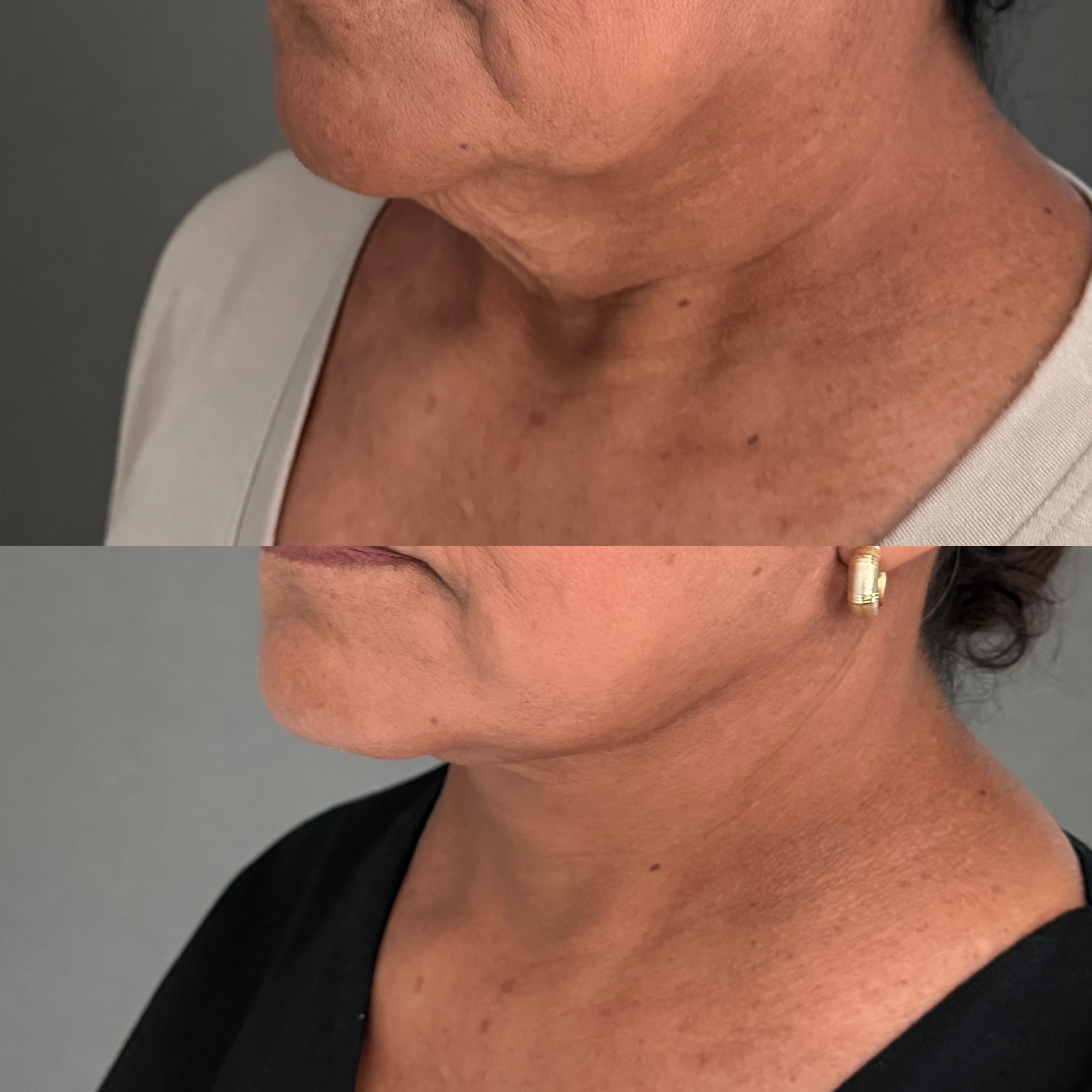 NECKLIFT