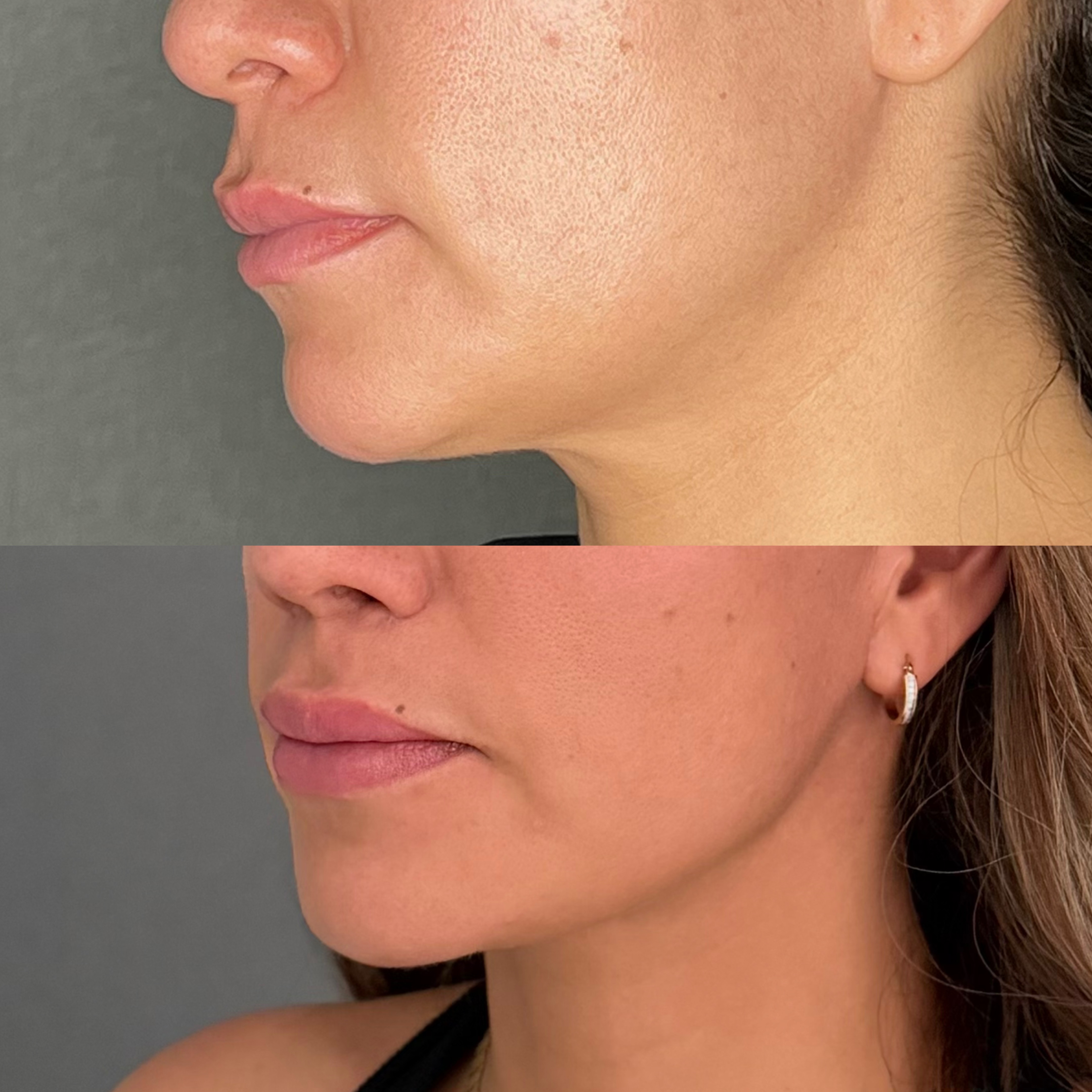NECKLIFT