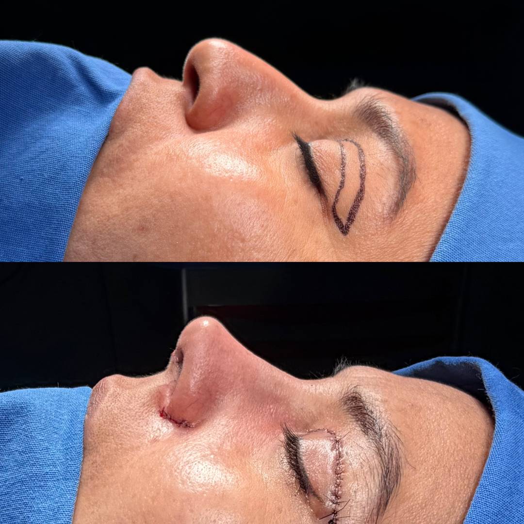 RINOPLASTIA CON BLEFAROPLAST