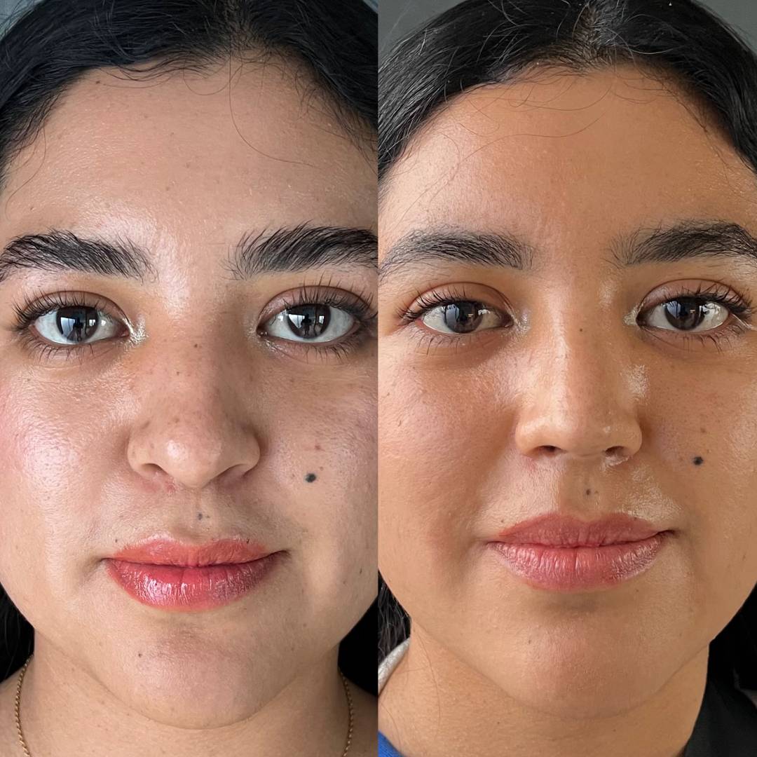RINOPLASTIA PRIMARIA
