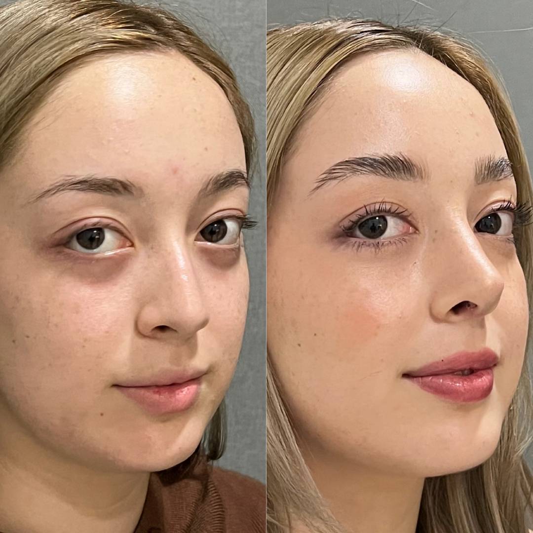 RINOPLASTIA PRIMARIA