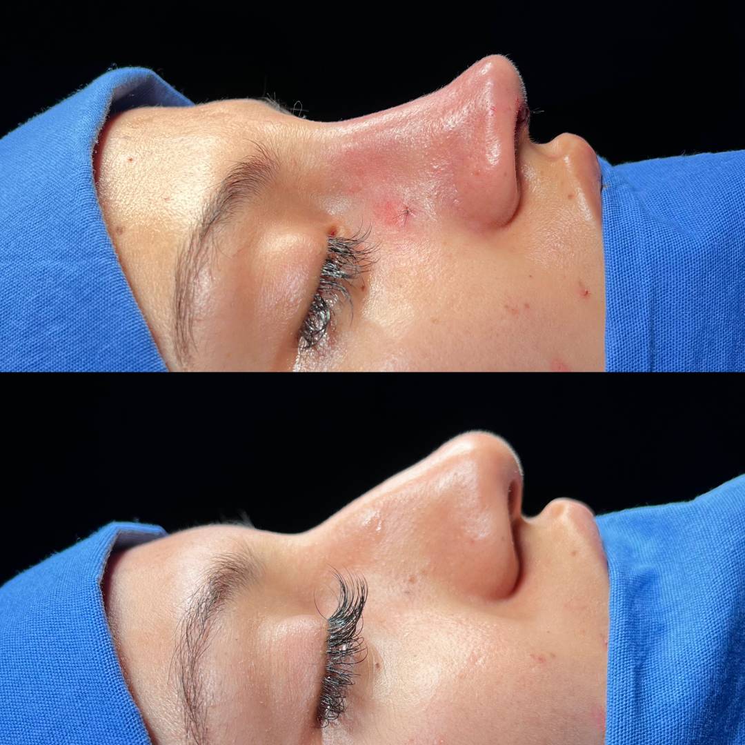 RINOPLASTIA PRIMARIA