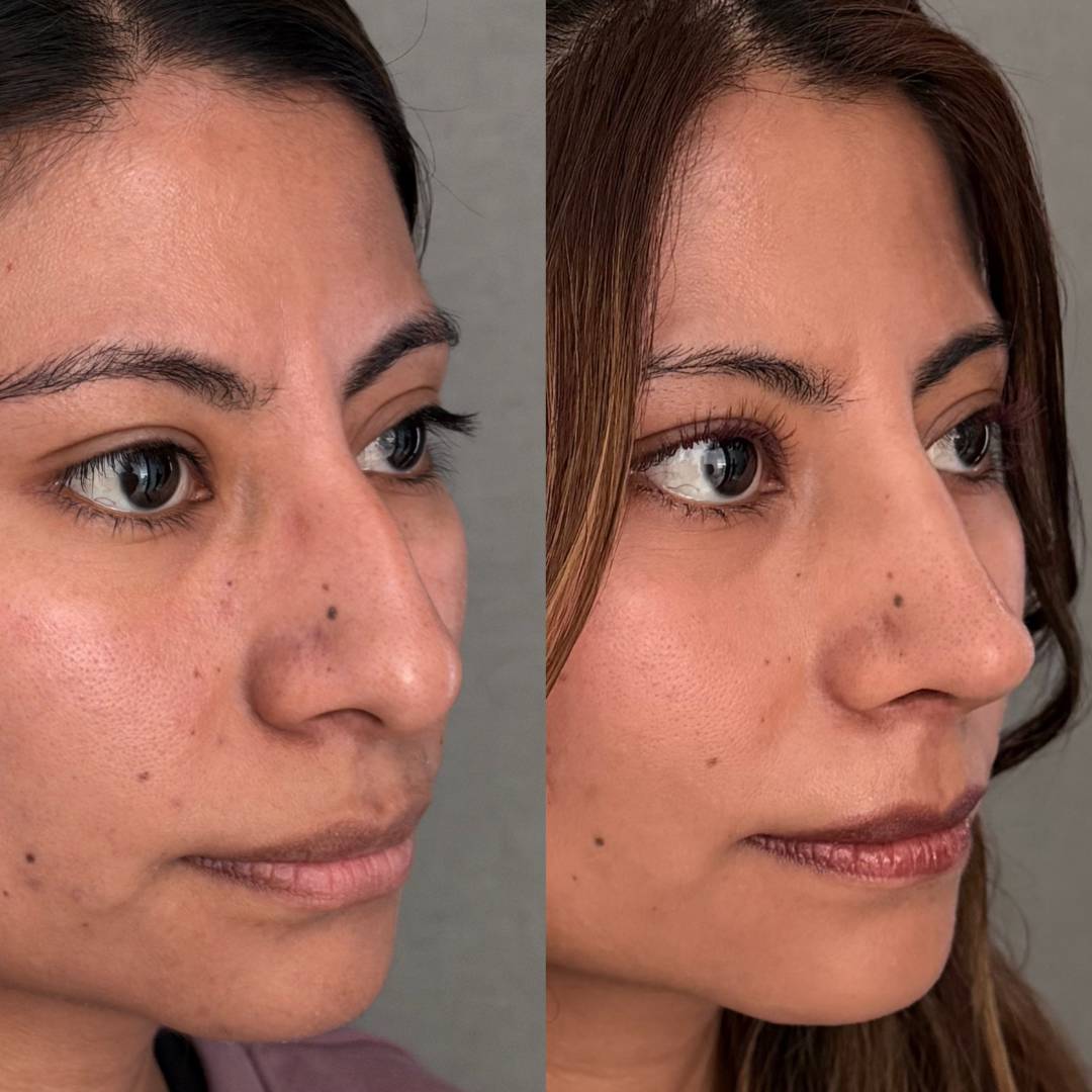 RINOPLASTIA PRIMARIA