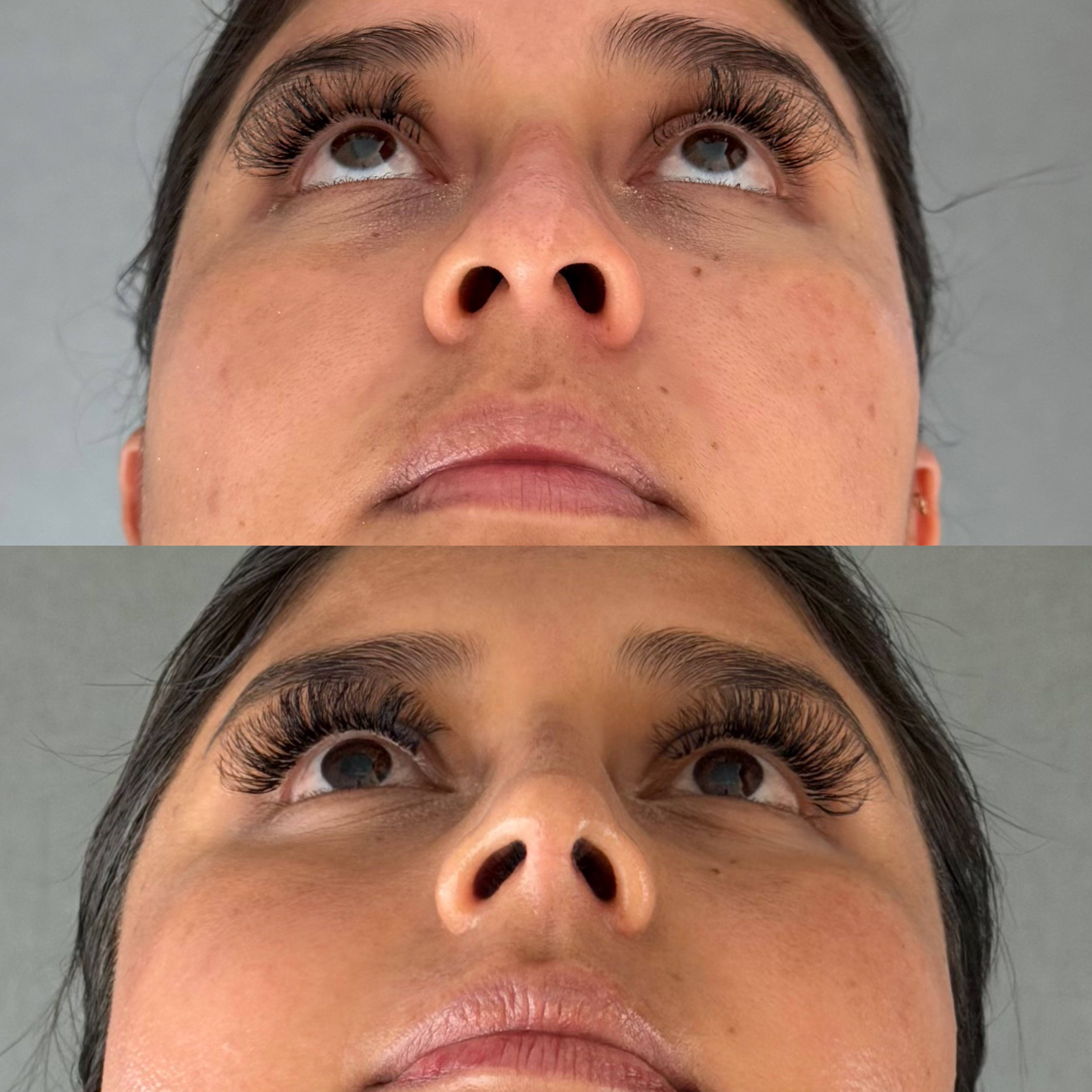 RINOPLASTIA PRIMARIA
