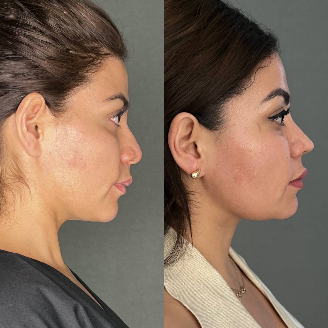 RINOPLASTIA PRIMARIA