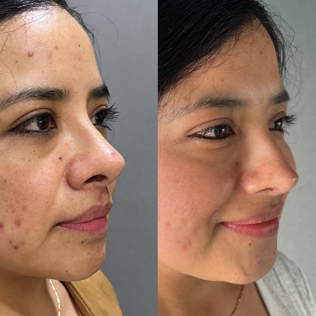 RINOPLASTIA SECUNDARIA